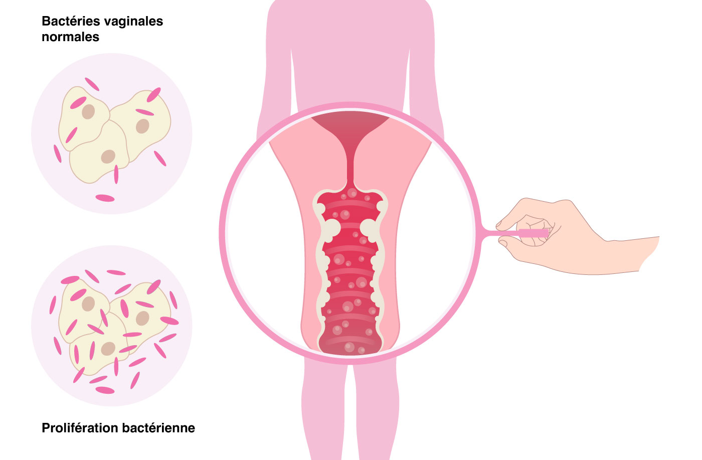 Bacterial Vaginosis Diagram